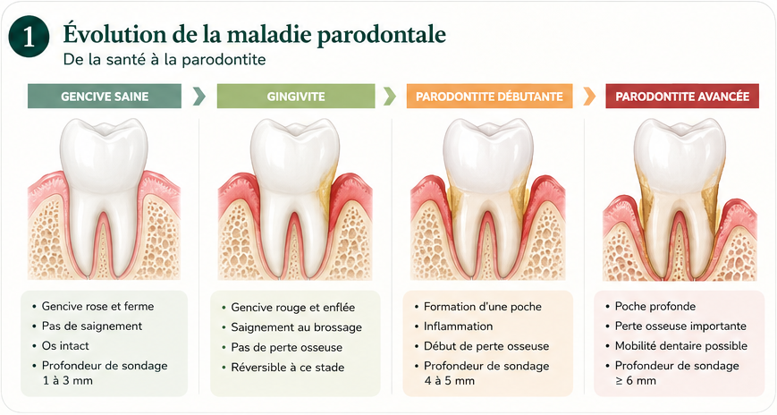 Évolution de la gencive saine vers la parodontite avancée