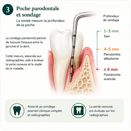 Sonde parodontale mesurant une poche autour d'une dent