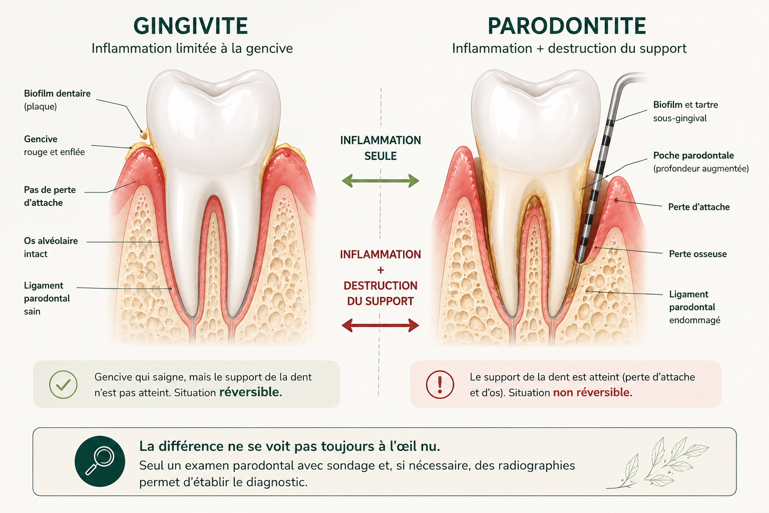 Comparaison illustrée entre gingivite et parodontite